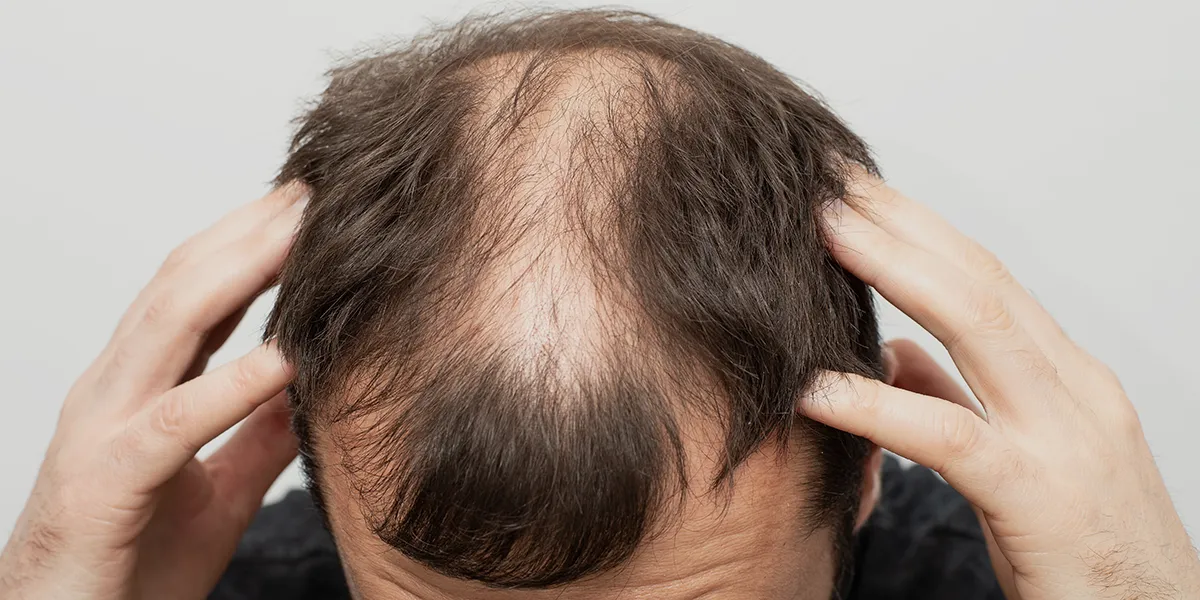 This Guy Just Shared 5 Tips for Hiding a Receding Hairline