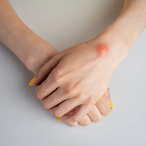 Lipoma