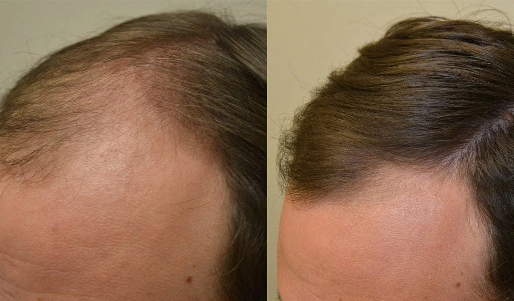 Remedies For Hair Loss And Regrowth