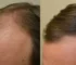 Remedies For Hair Loss And Regrowth