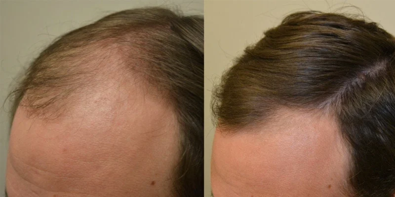 Remedies For Hair Loss And Regrowth