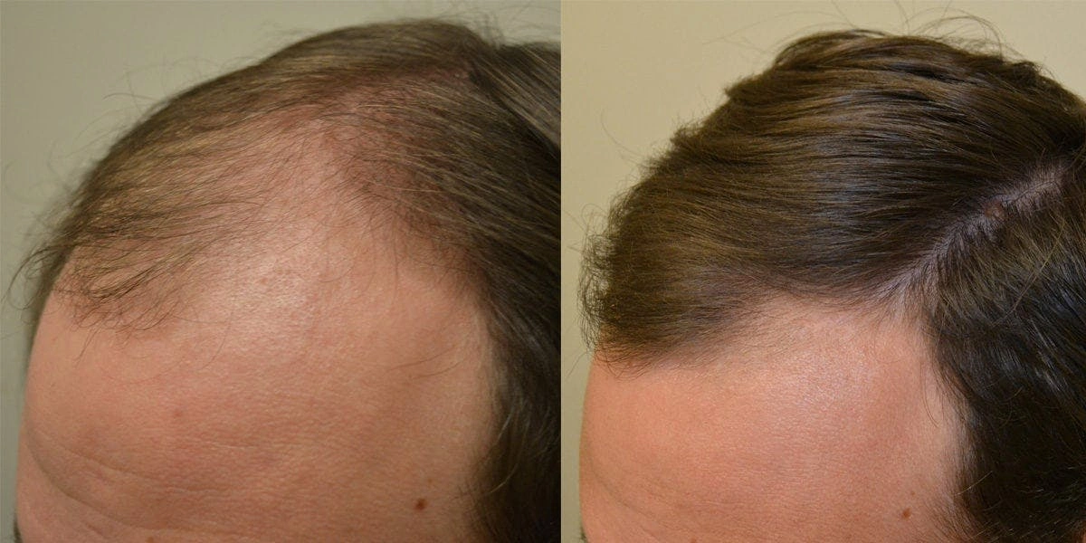 Remedies For Hair Loss And Regrowth
